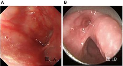 Application of Gastroscopy in the Diagnosis of Congenital Pyriform Sinus Fistula in Children